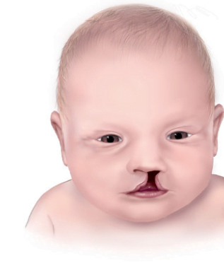 bibir sumbing bibir sumbing