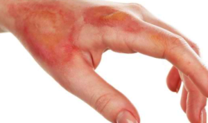 luka bakar luka bakar