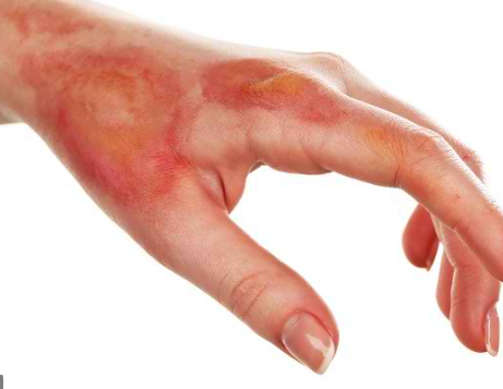 luka bakar luka bakar