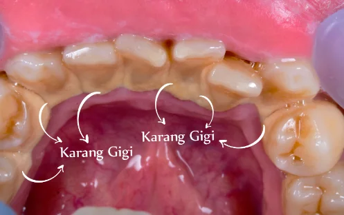 karang gigi karang gigi