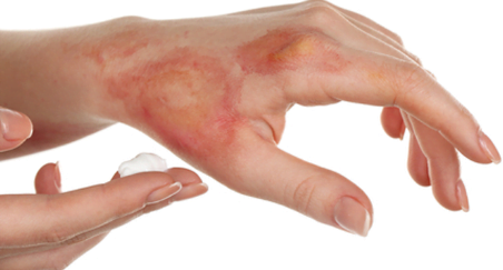 luka bakar luka bakar